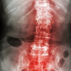 Scoliosis Masterclass