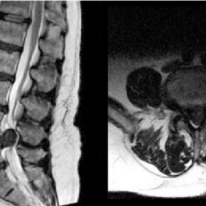 Radiology Masterclass  |  Disc Herniations