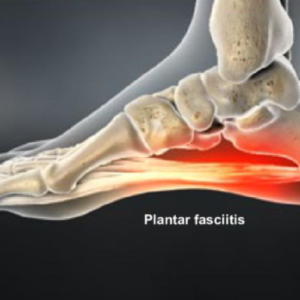Plantar Fasciitis Masterclass
